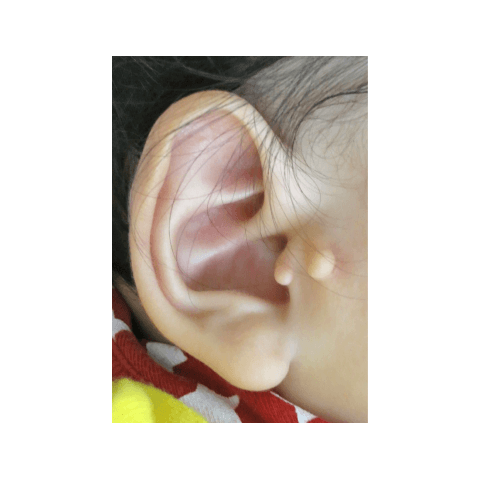 副耳
