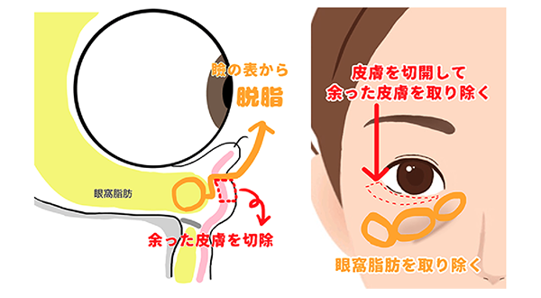 瞼の表からの脱脂（余った皮膚を取り除き、眼窩脂肪を取り除く）