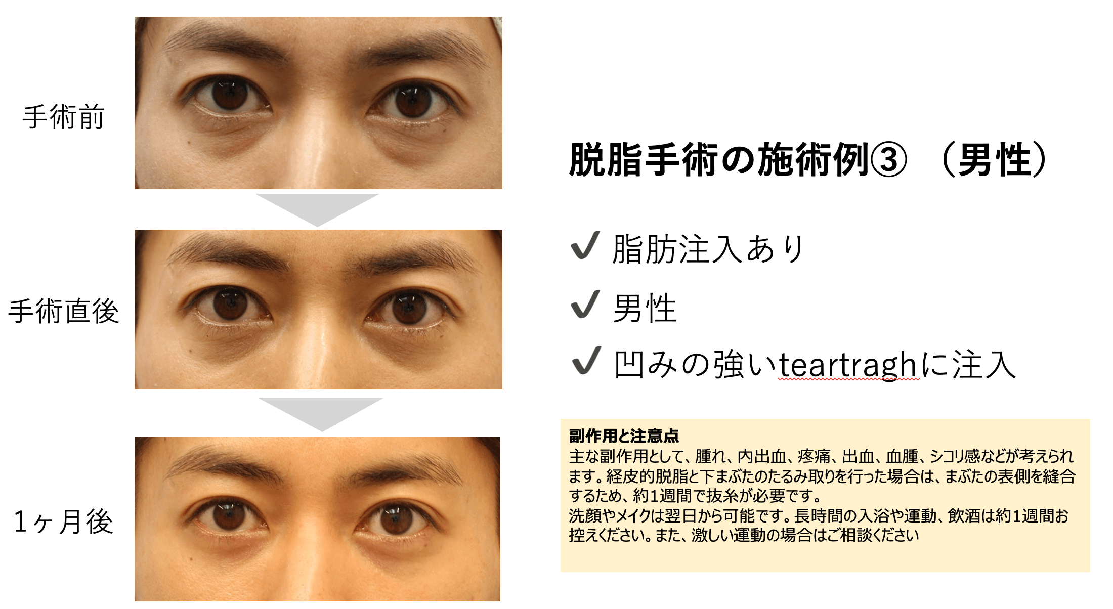 脱脂手術の例3