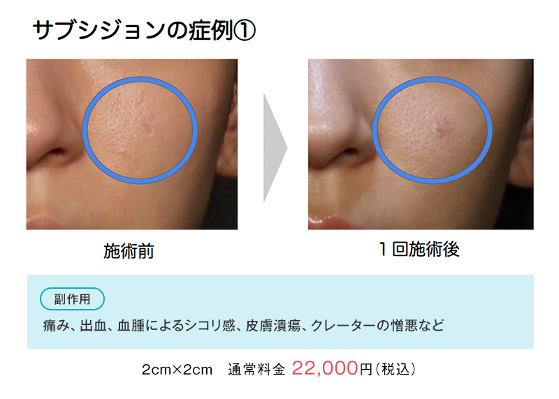 サブシジョンの症例①