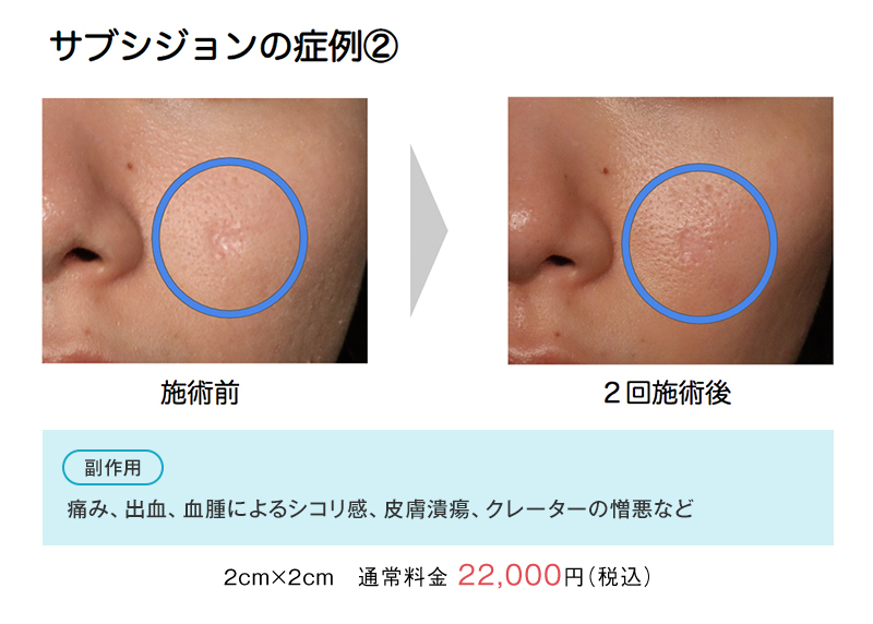 サブシジョンの症例②