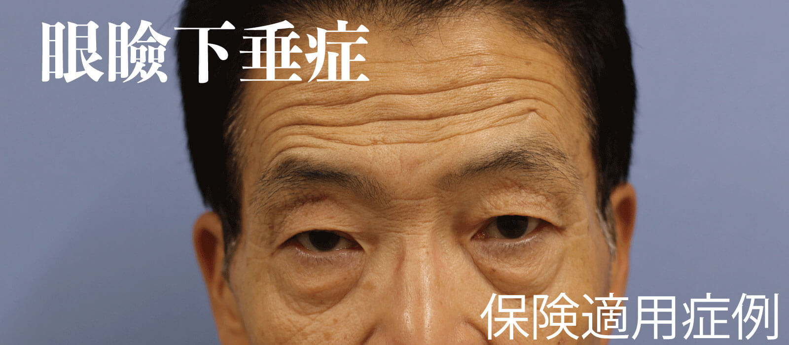 コーヒーは眼瞼炎を悪化させますか?