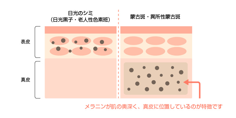 東京都渋谷区笹塚にあるこたろクリニックの異所性蒙古斑の画像