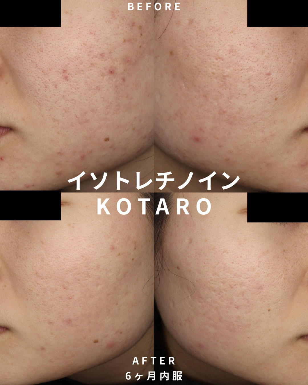 イソトレチノインの治療経過①