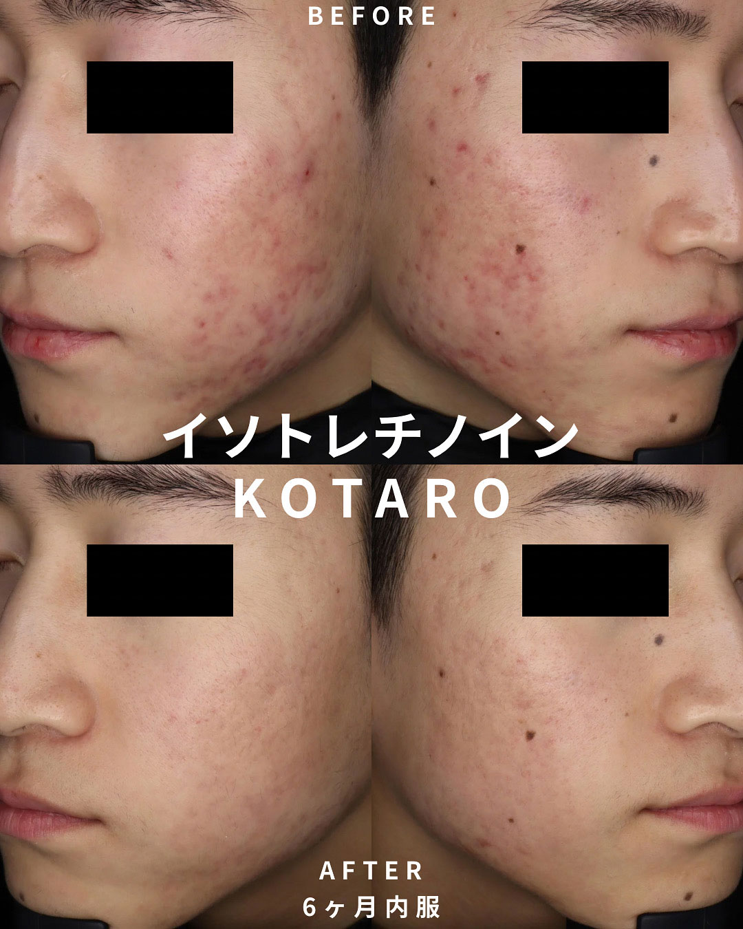 イソトレチノインの治療経過②