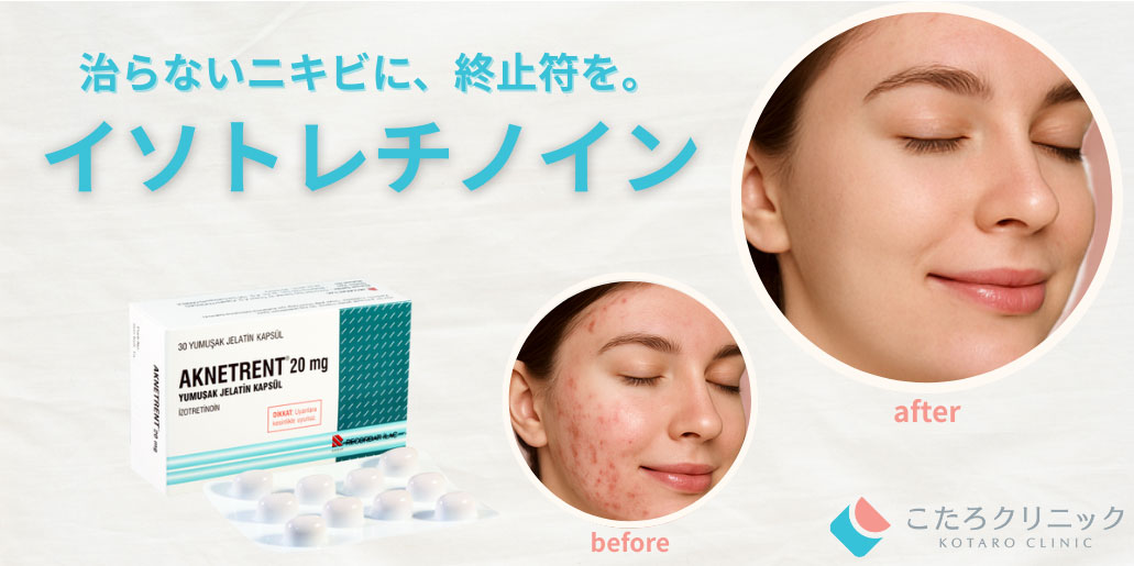 イソトレチノイン