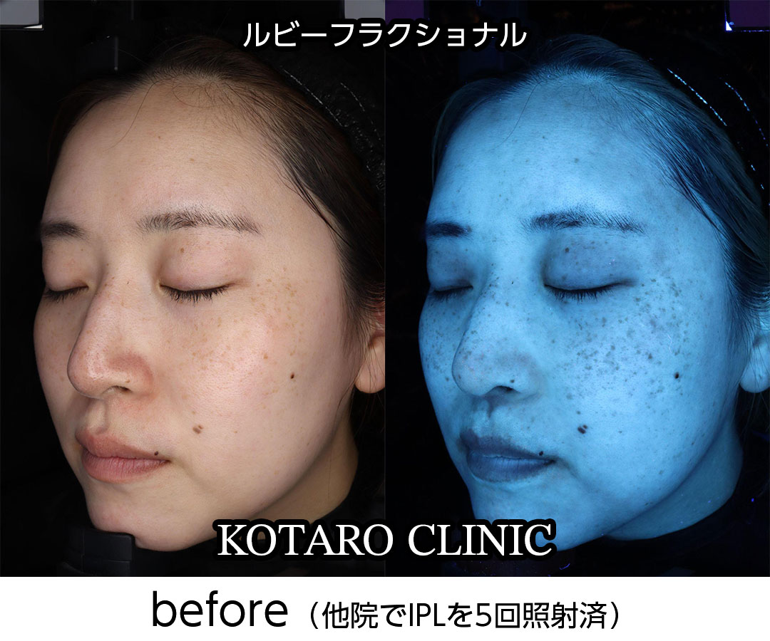 ルビーフラクショナルの治療経過① Before