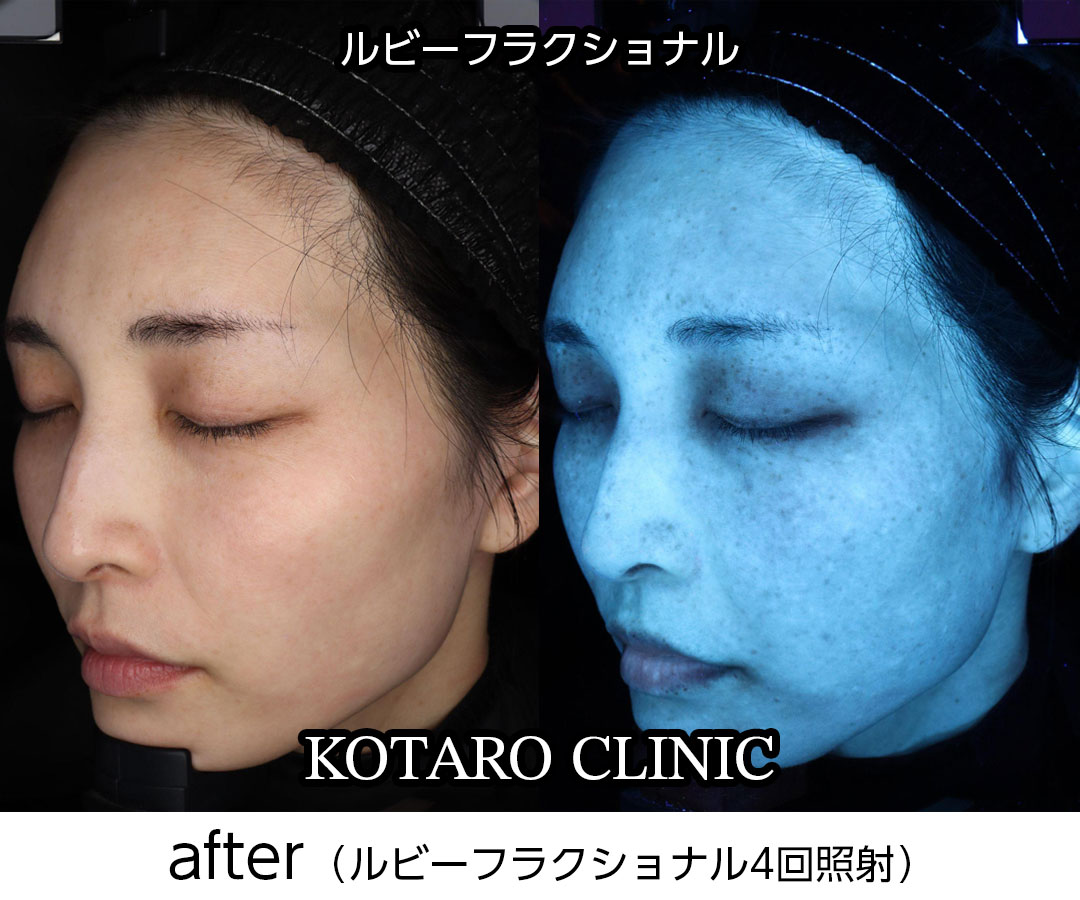 ルビーフラクショナルの治療経過② After