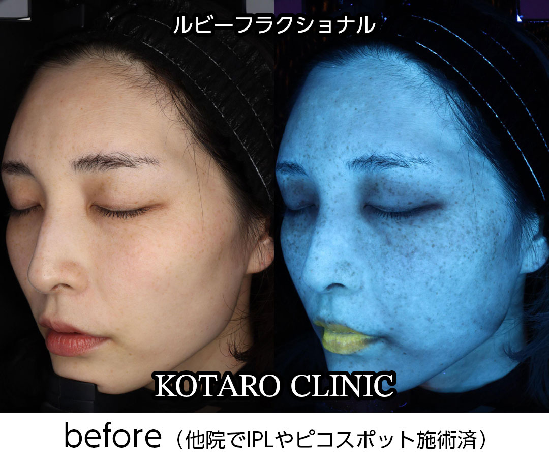 ルビーフラクショナルの治療経過② Before