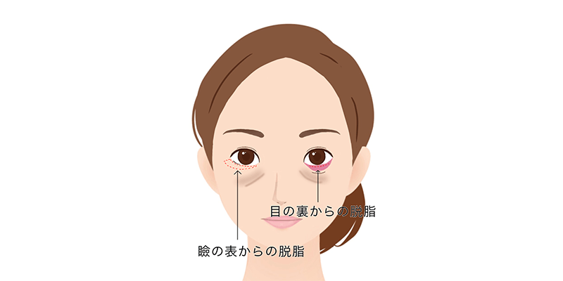 瞼の裏からの脱脂と瞼の表からの脱脂