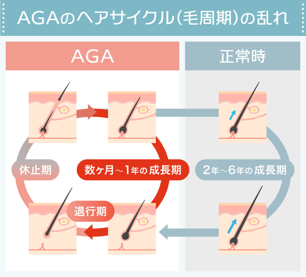 なぜ薄毛になるのか？ヘアサイクル (毛周期) の乱れ