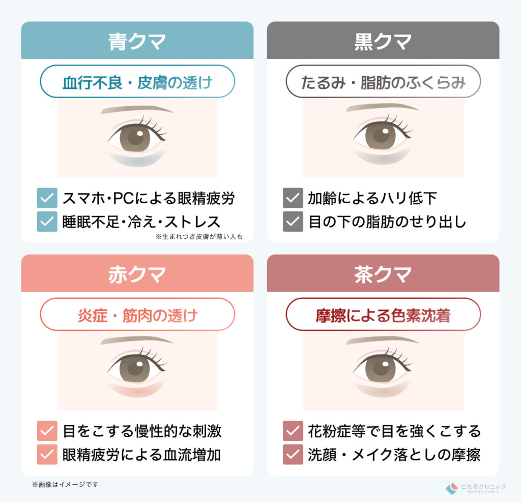 目の下のクマの種類別の原因
