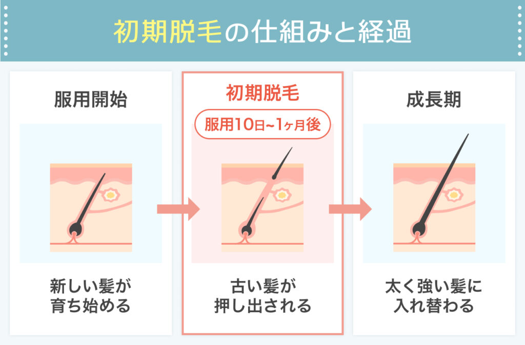 治療開始直後に起きる初期脱毛の正体