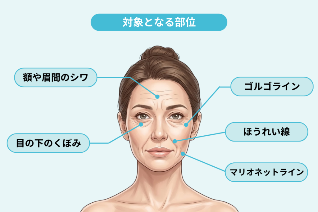 ヒアルロン酸注射によるシワ取りとは