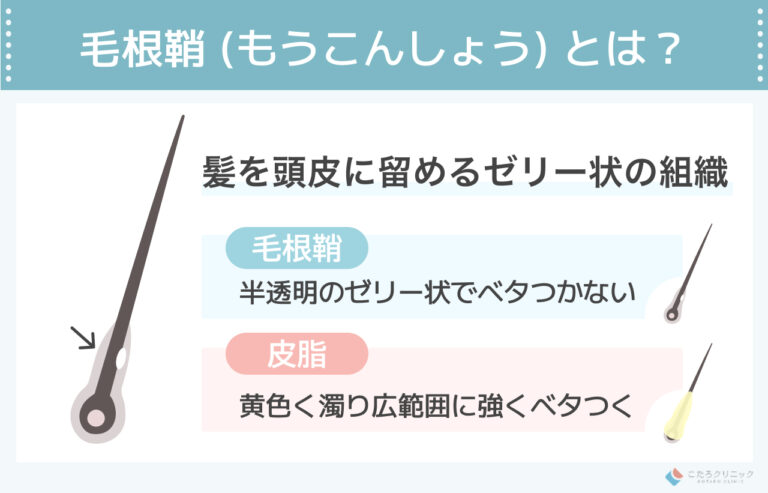 毛根鞘 (白い塊) が巨大な理由は?きれいに抜くコツと抜くとどうなるか徹底解説 | 笹塚駅前こたろ形成皮ふ科クリニック | 京王線「笹塚」駅 ...