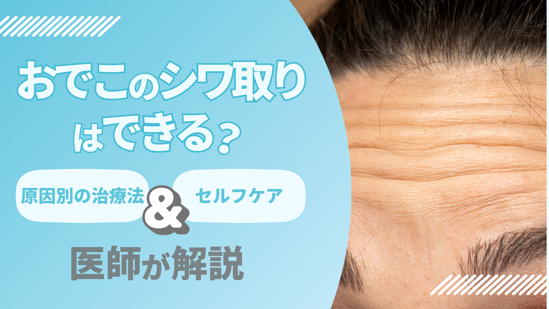 おでこシワ取りアイキャッチ