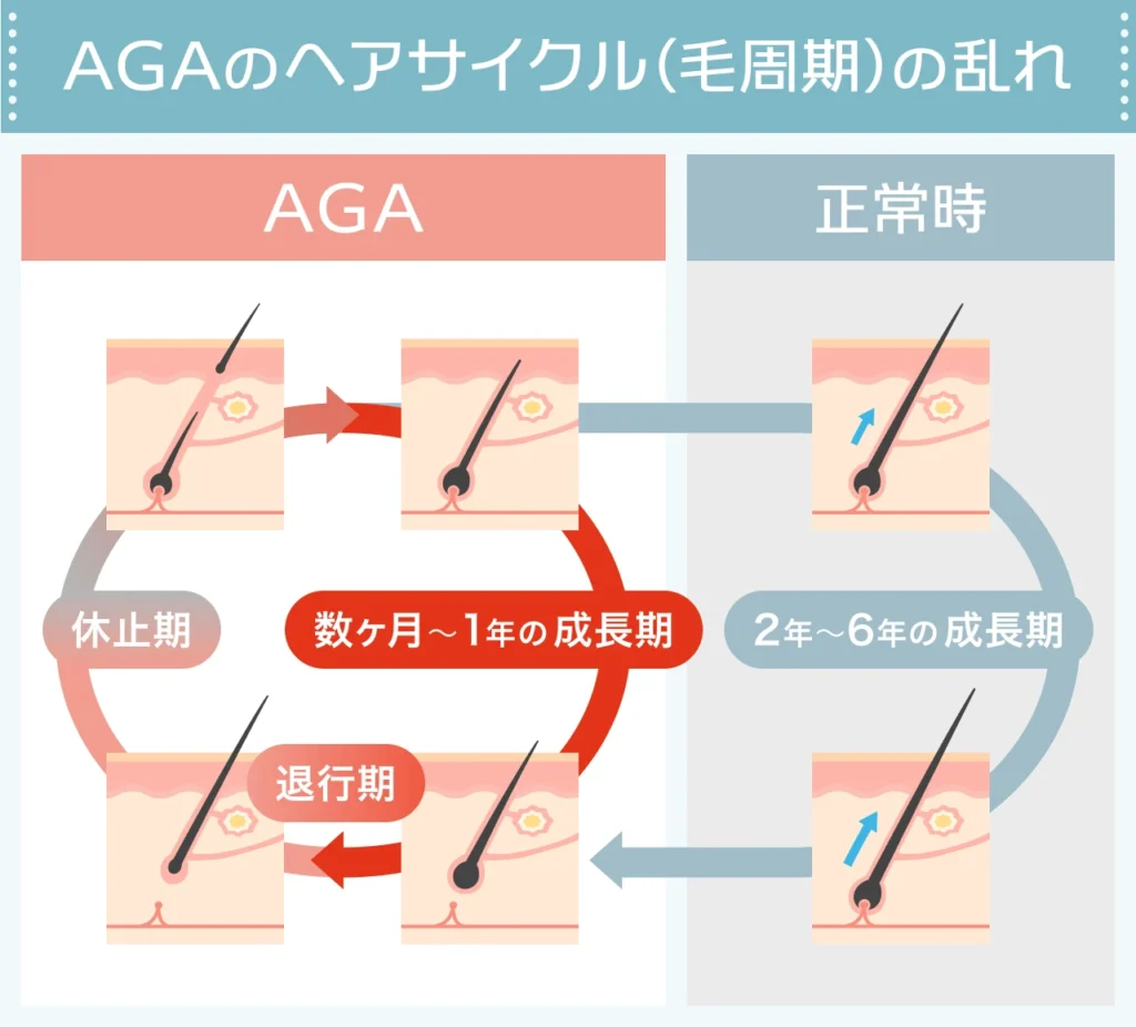 なぜ薄毛になるのか？ヘアサイクル (毛周期) の乱れ