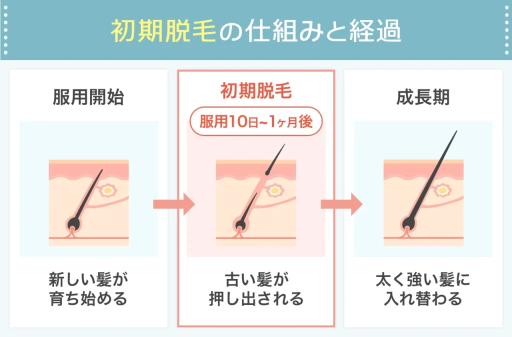 AGA治療開始直後に起きる初期脱毛の正体