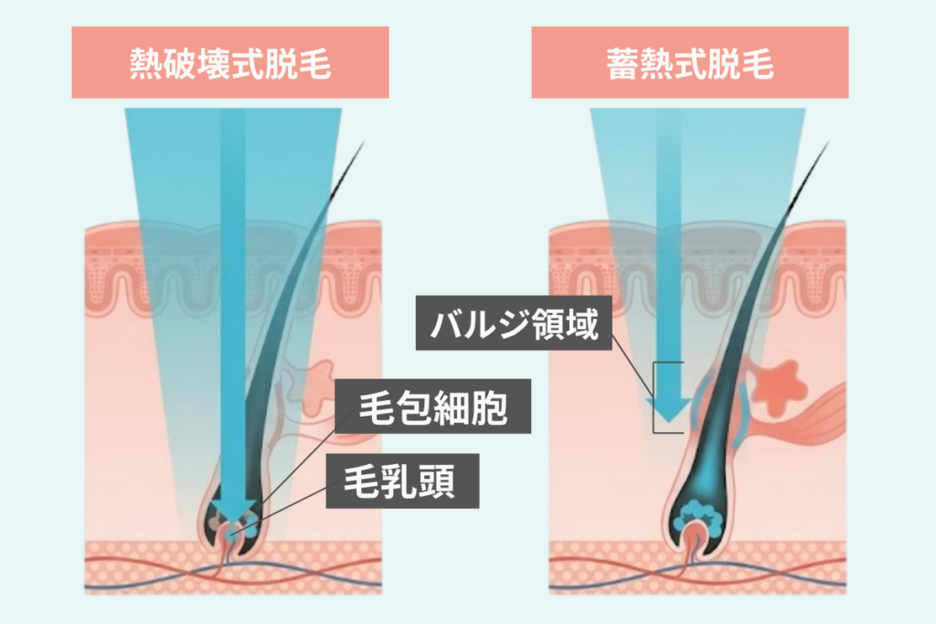 医療脱毛で使われるレーザーの種類