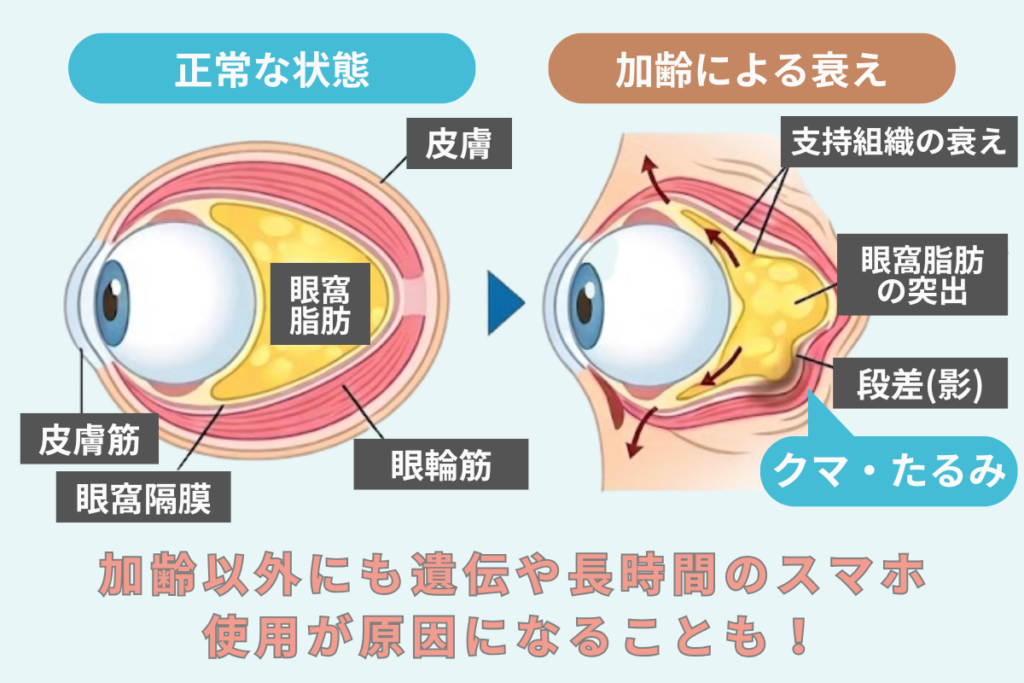 目の下のクマ・たるみはなぜ起きる？