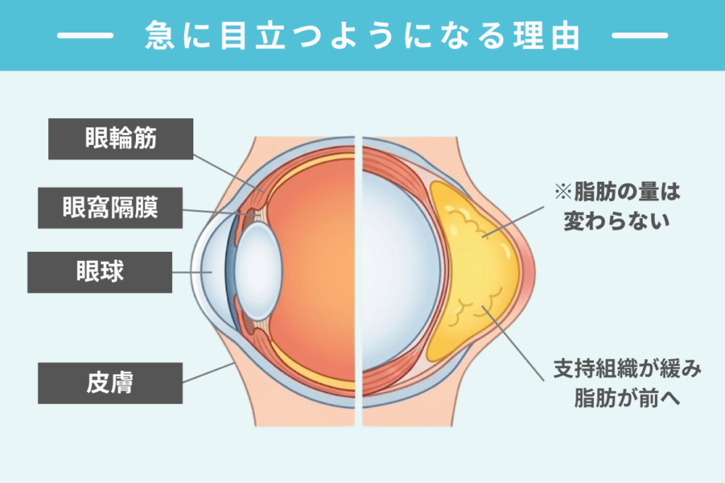 目の下の膨らみが急に目立つようになる理由
