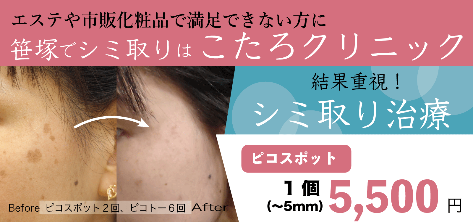 エステや市販化粧品で満足できない方に 笹塚でシミ取りはこたろクリニック　結果重視！シミ取り治療　ピコスポット 5mm以下1つ 5,500円