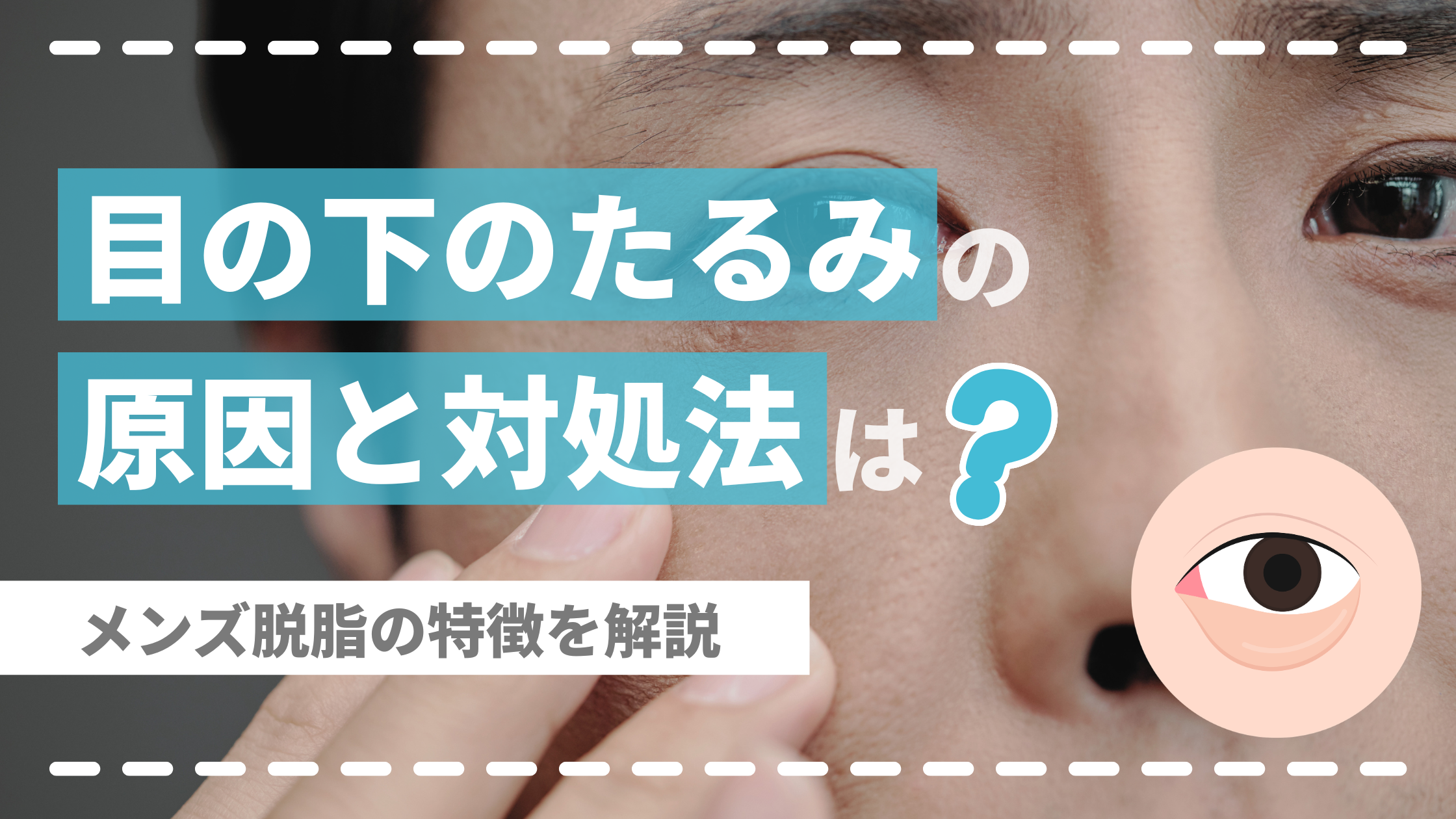男性の目の下のたるみの原因と治し方は？メンズ脱脂の特徴を解説【医師監修】