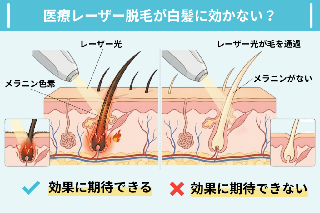 VIOニードル脱毛とは？レーザーが使えない毛に対応できる理由