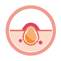 ニキビ・ニキビ跡