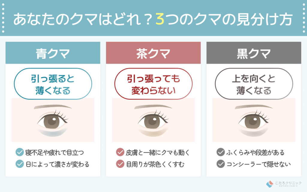 あなたの目の下のクマの正体は？3つの種類と簡単な見分け方