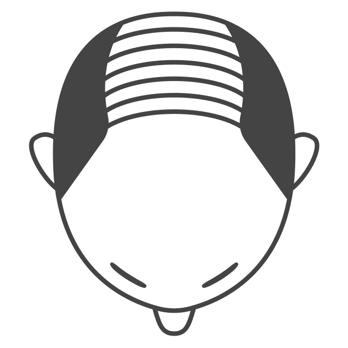 U字ハゲ