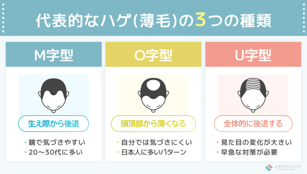 【特徴一覧】代表的なハゲ (薄毛) の種類とパターン