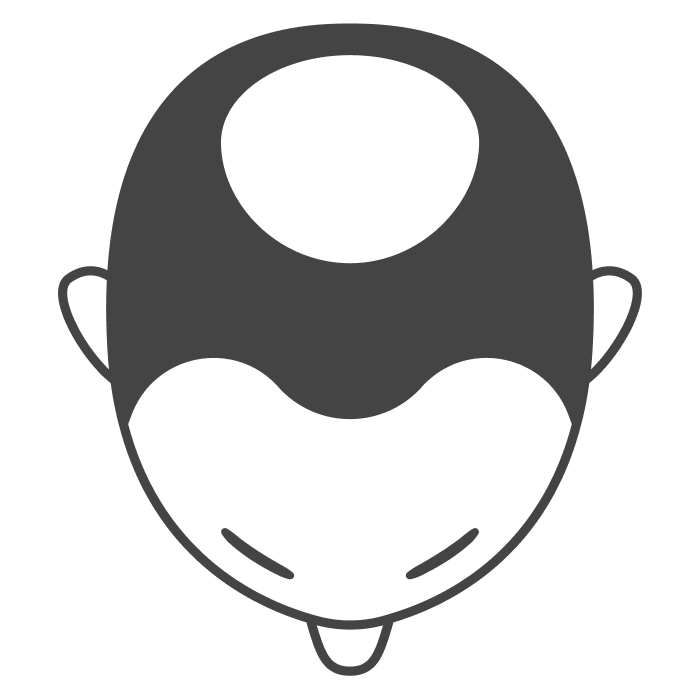 O字ハゲ