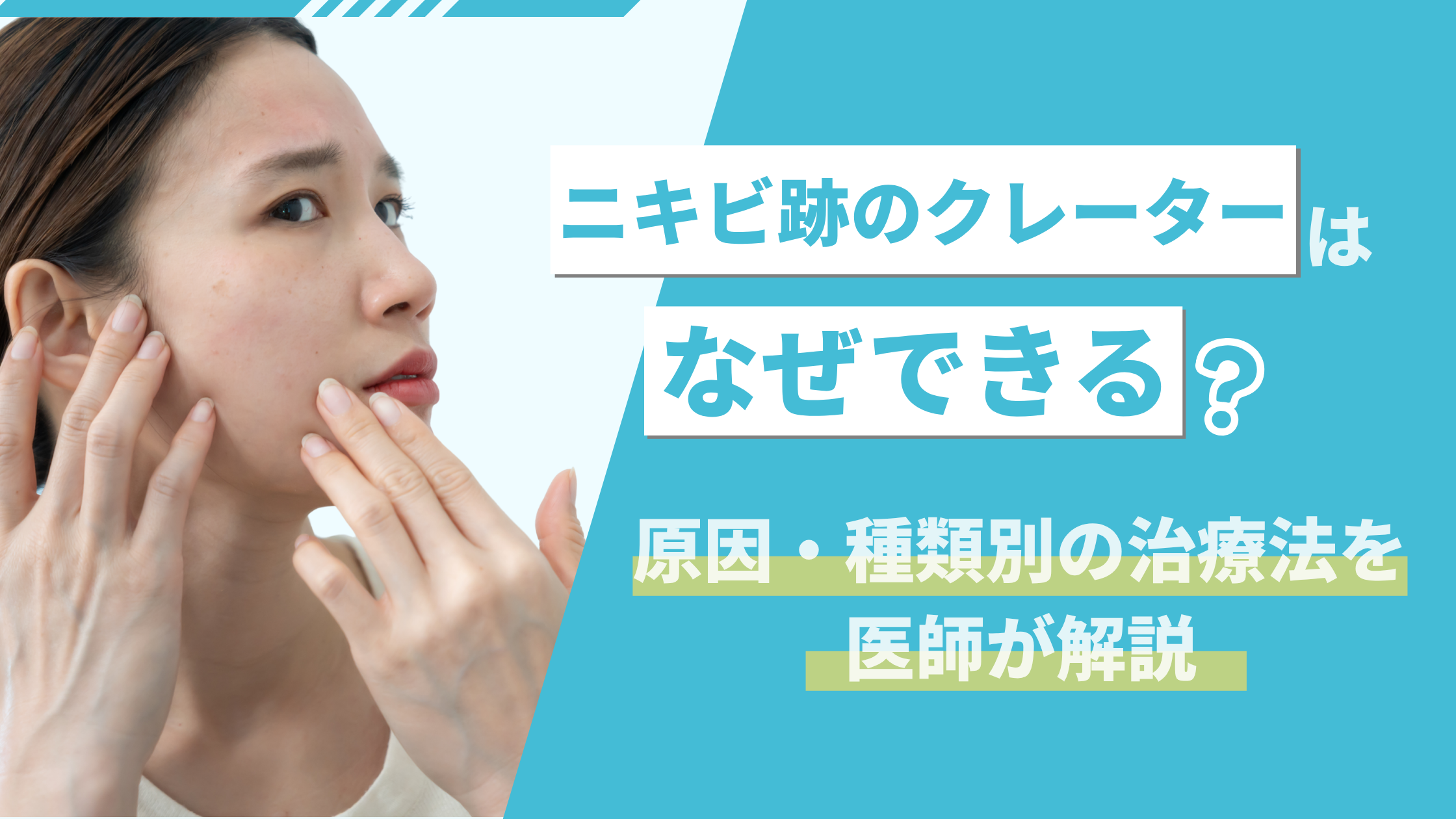 ニキビ跡のクレーター
