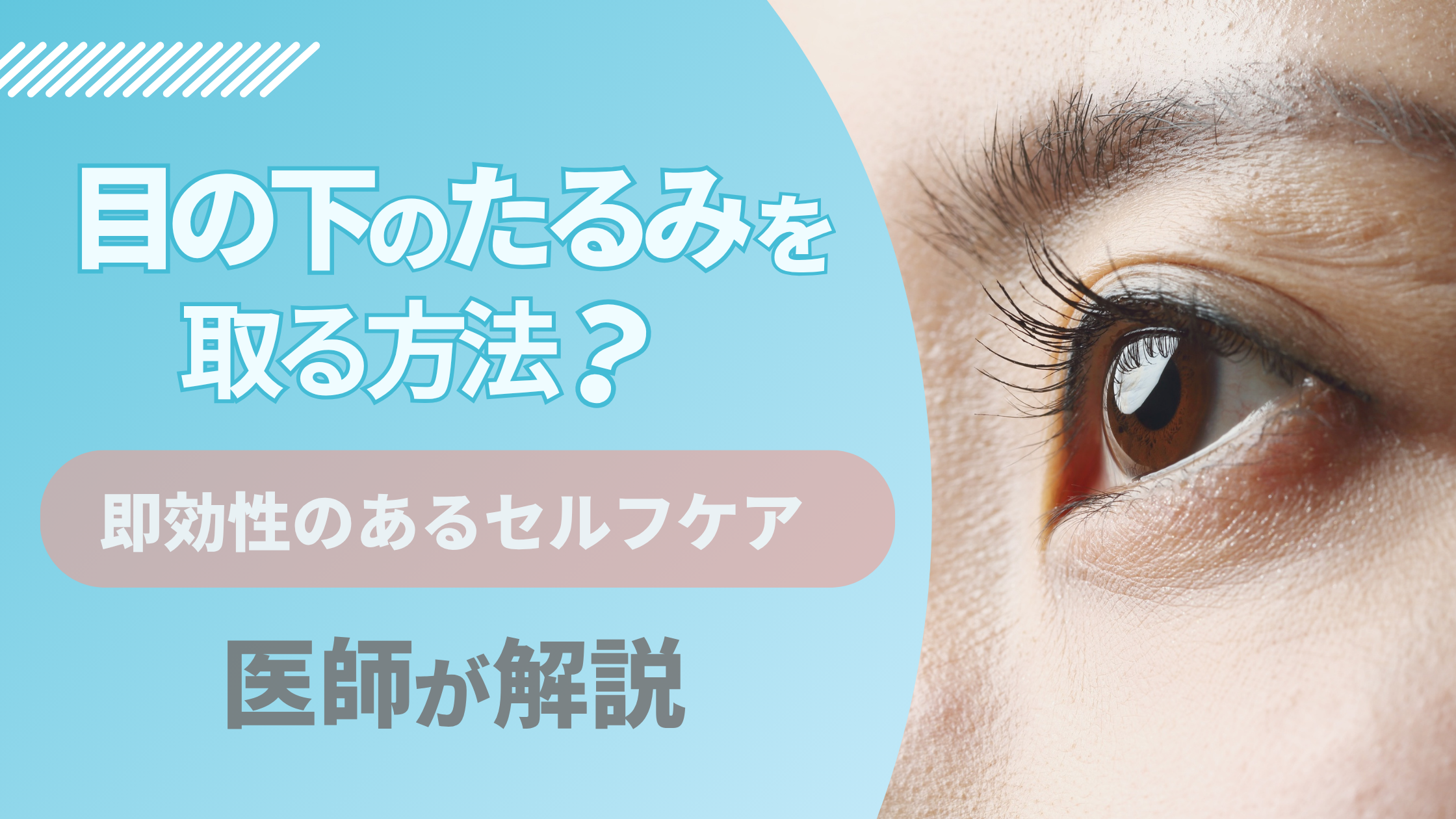 目の下のたるみを取る方法!即効性のあるセルフケアと医療治療を解説