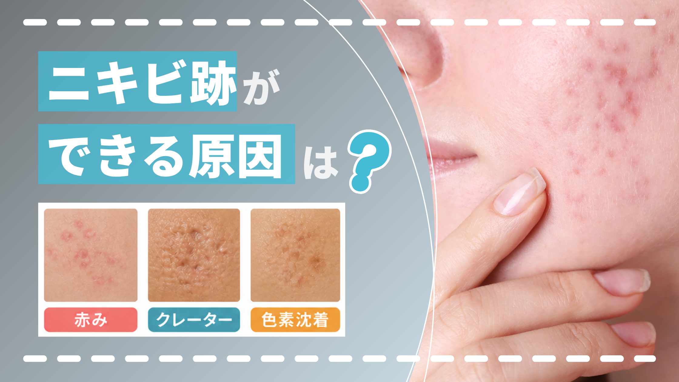 ニキビ跡ができる原因は?種類別のメカニズムと予防法を解説【医師監修】