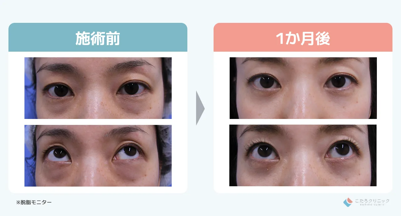 脱脂のみの仕上がり経過（術後1ヶ月〜3ヶ月）_症例3