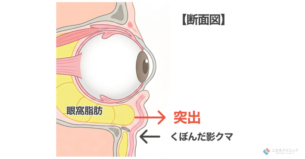 目の下のたるみ・ふくらみの正体 (眼窩脂肪) とは
