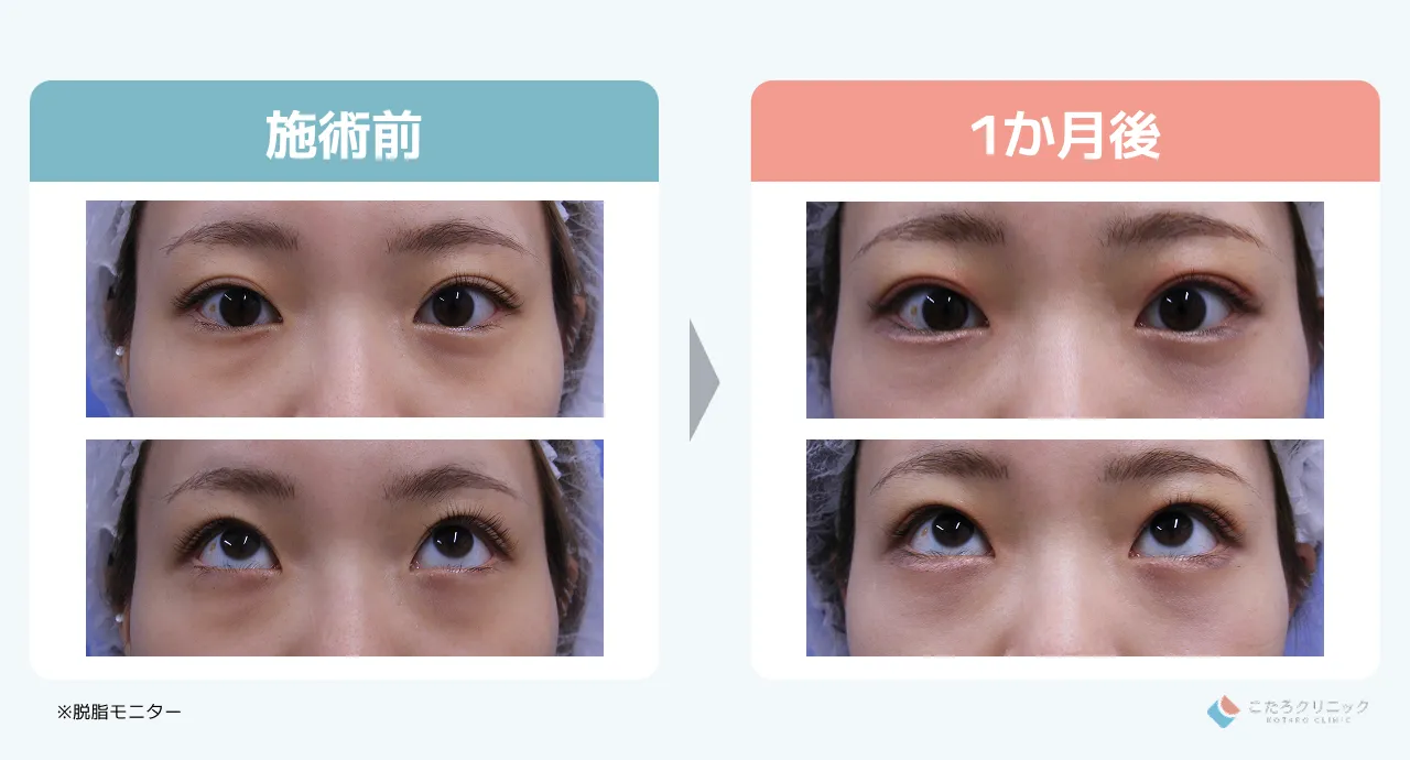 脱脂のみの仕上がり経過（術後1ヶ月〜3ヶ月）_症例2