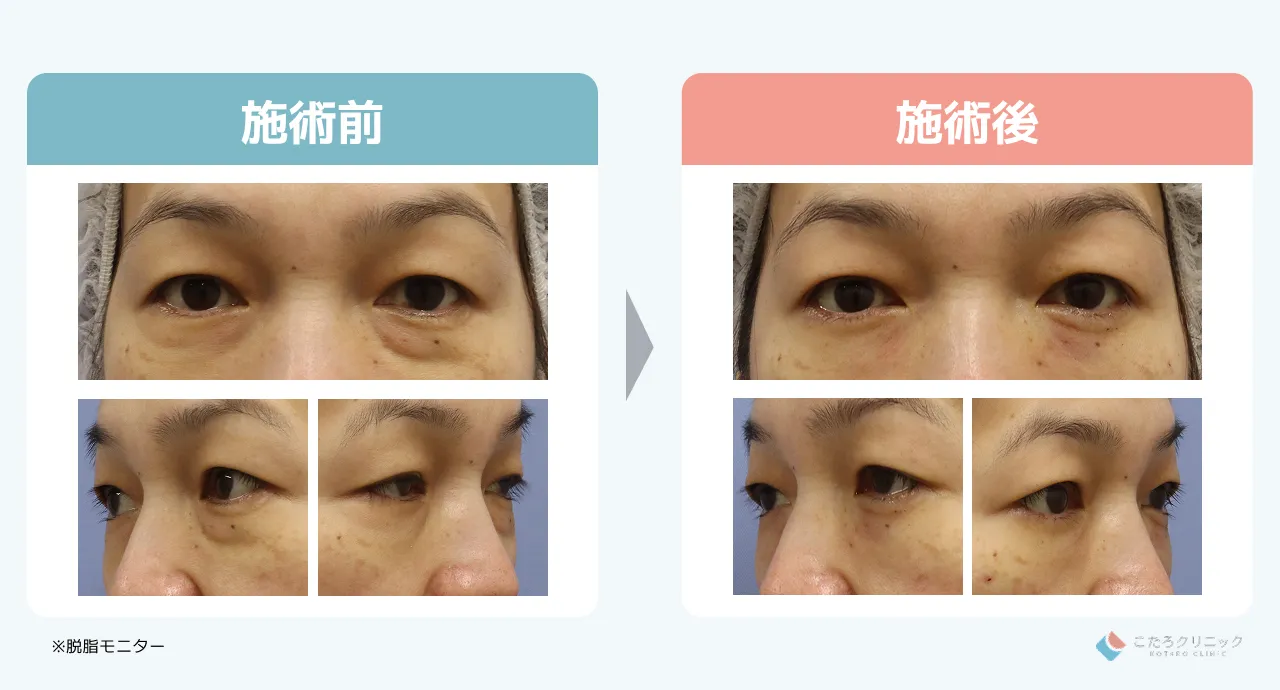 切らないクマ取り（脱脂）のダウンタイム経過_症例1
