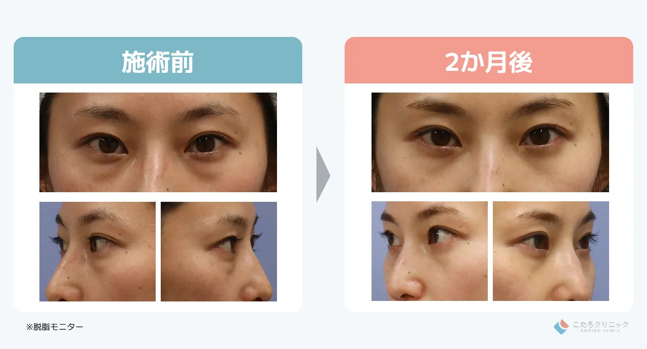 脱脂のみの仕上がり経過（術後1ヶ月〜3ヶ月）_症例4