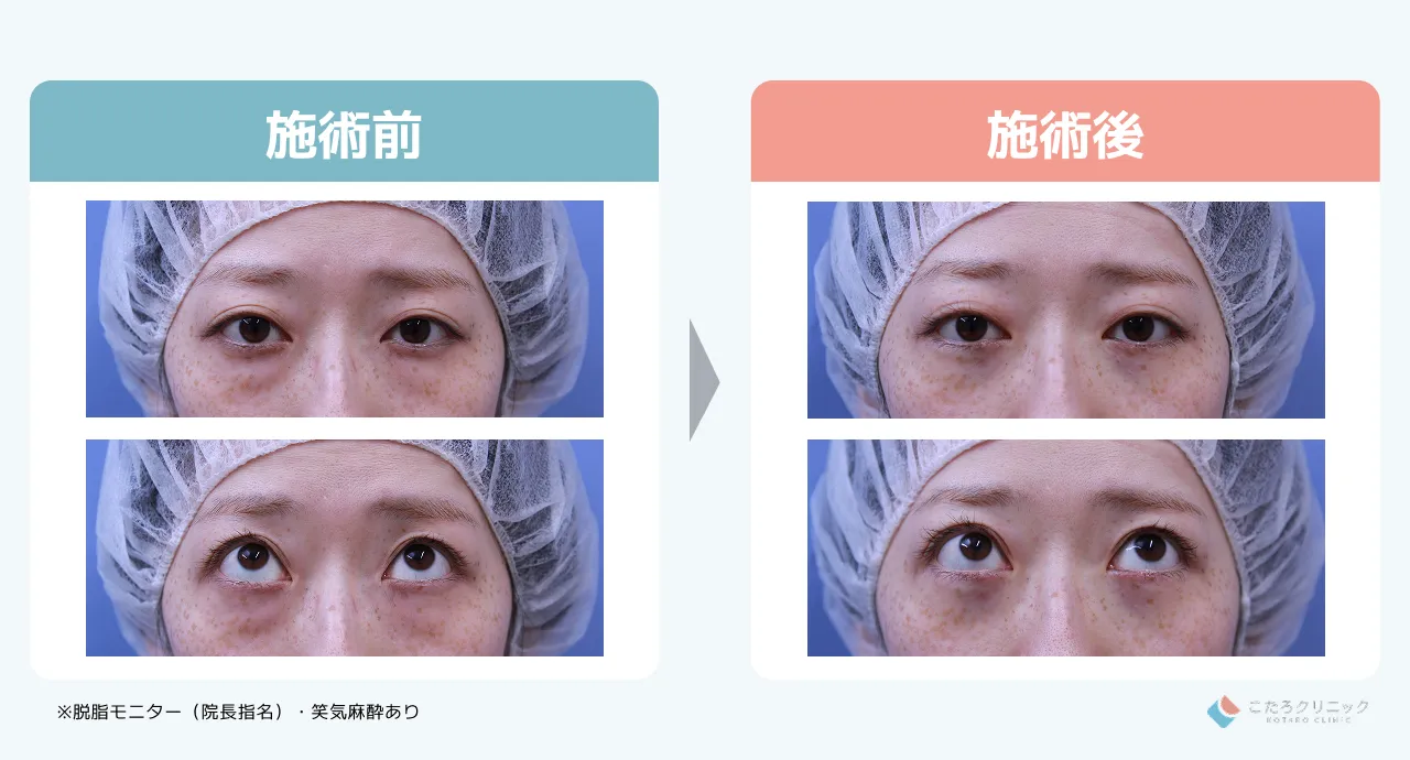 切らないクマ取り（脱脂）のダウンタイム経過_症例5