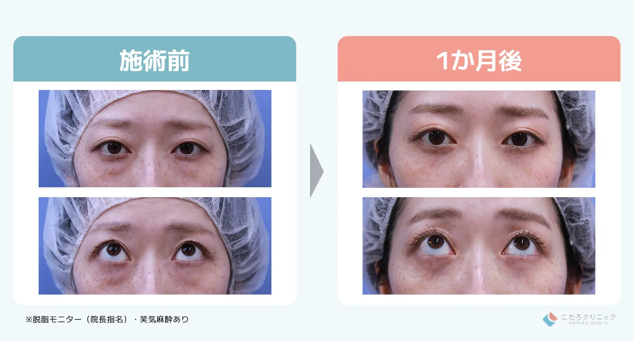 脱脂のみの仕上がり経過（術後1ヶ月〜3ヶ月）_症例5