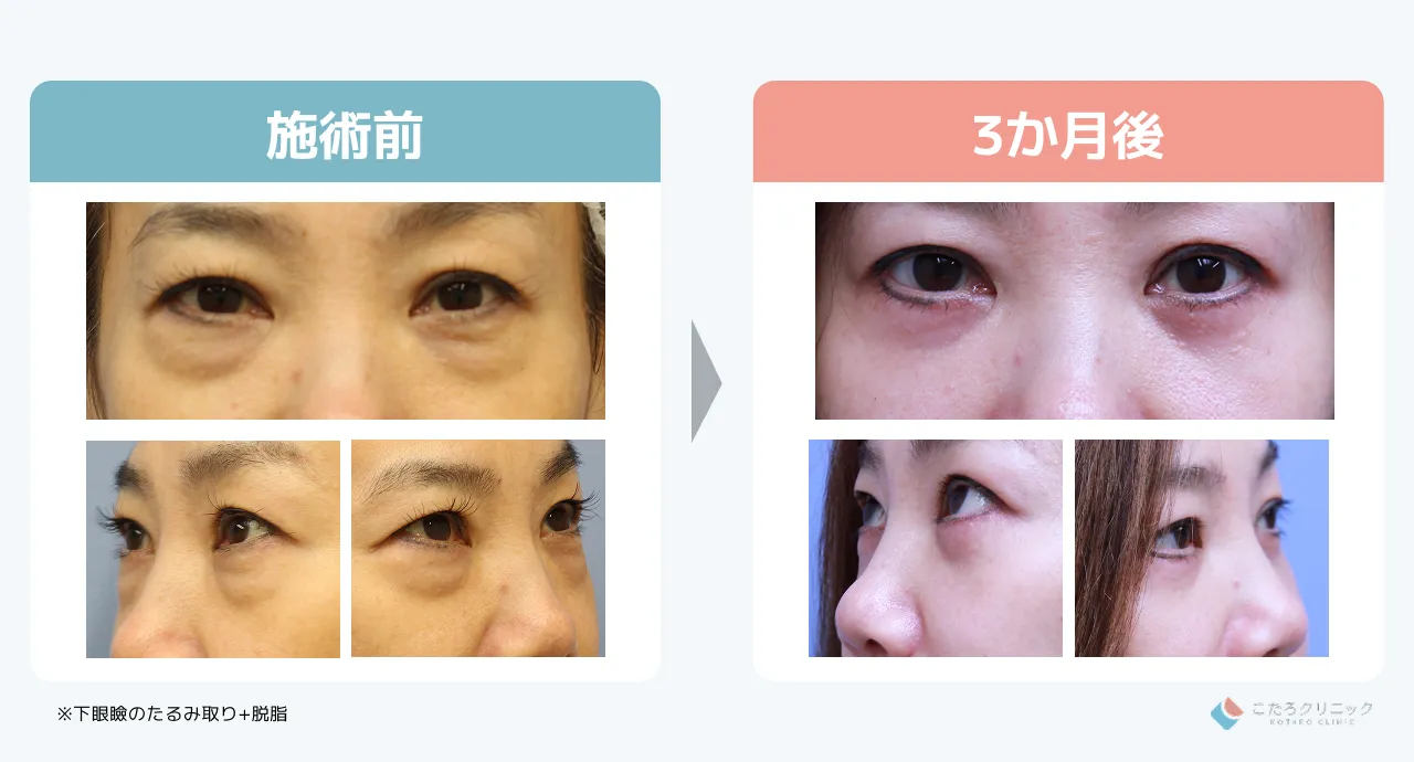 脱脂+たるみ取りの仕上がり経過（術後1ヶ月〜3ヶ月）_症例2