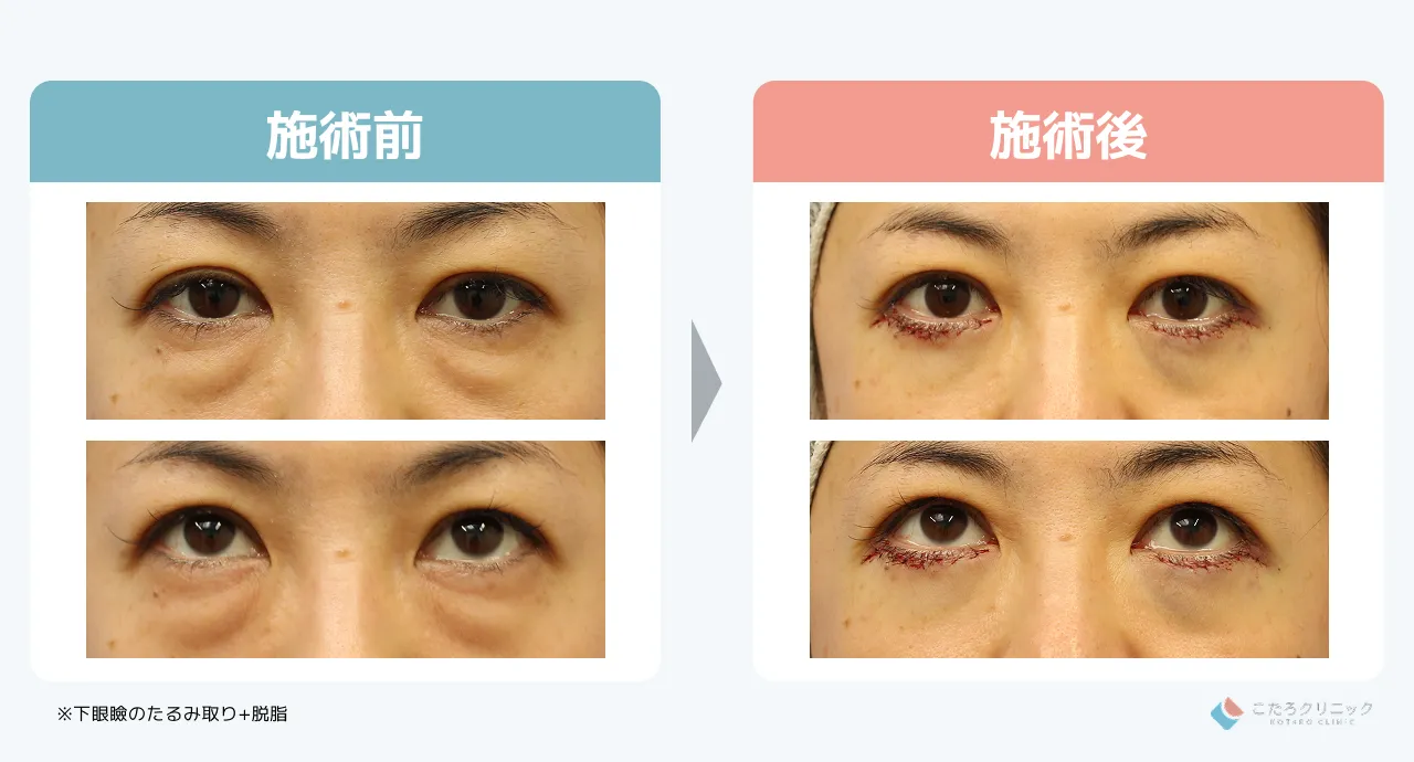 脱脂+たるみ取りのダウンタイム経過_症例2