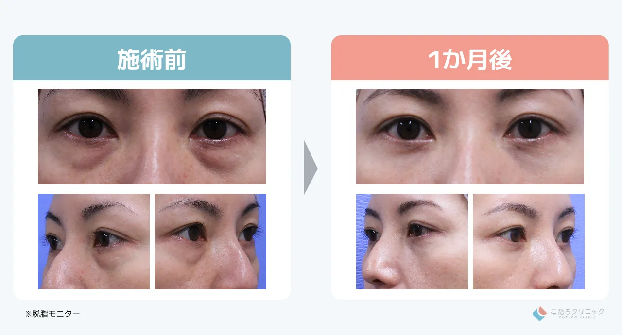 脱脂のみの仕上がり経過（術後1ヶ月〜3ヶ月）_症例6