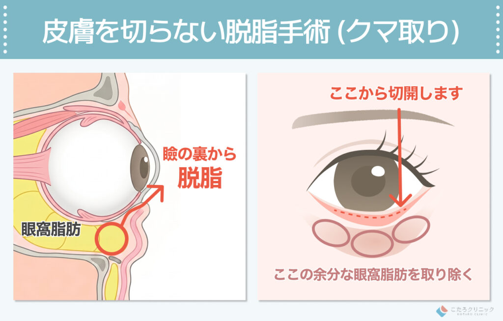 皮膚を切らない脱脂手術 (クマ取り)