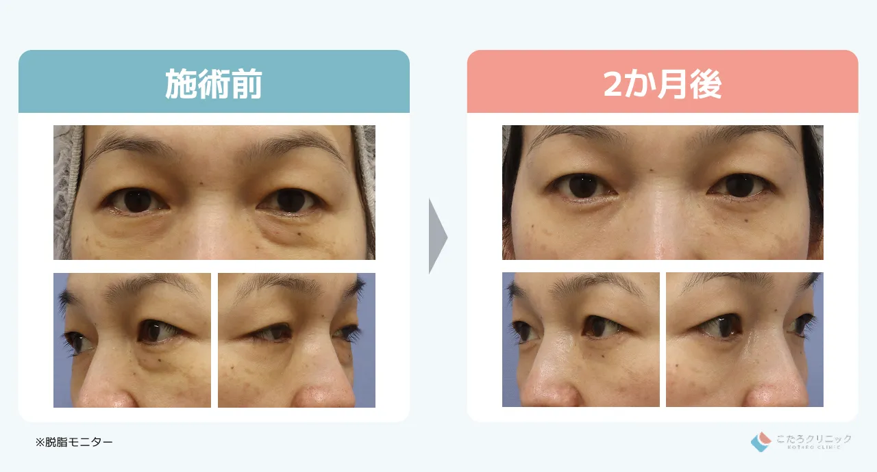 脱脂のみの仕上がり経過（術後1ヶ月〜3ヶ月）_症例1