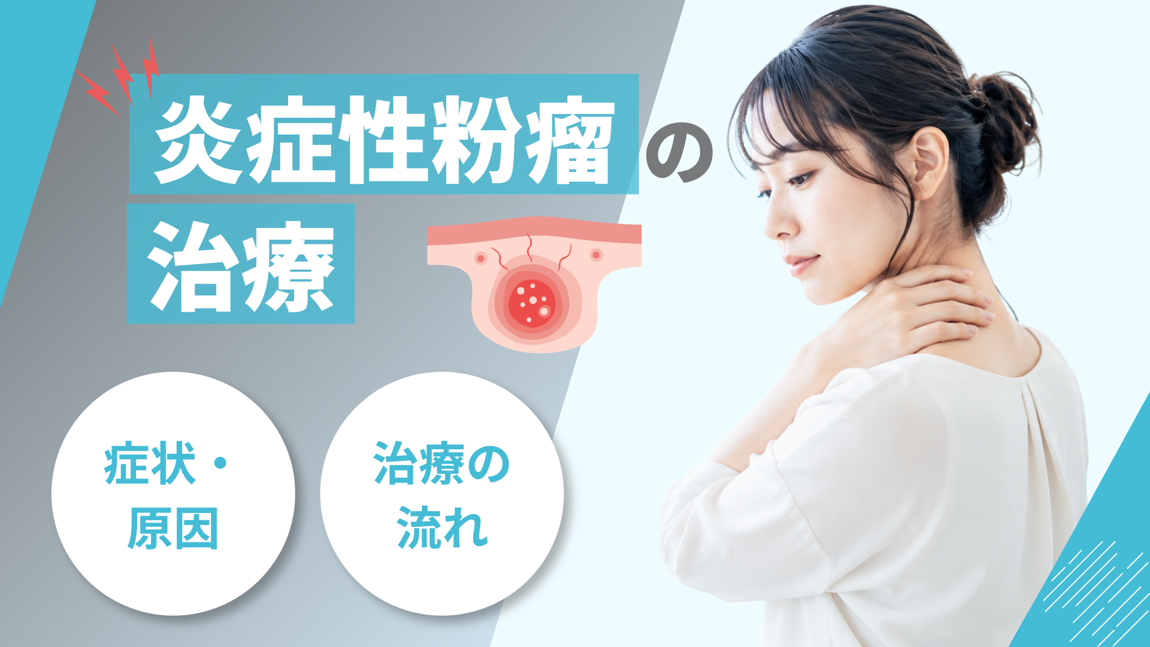 炎症性粉瘤アイキャッチ