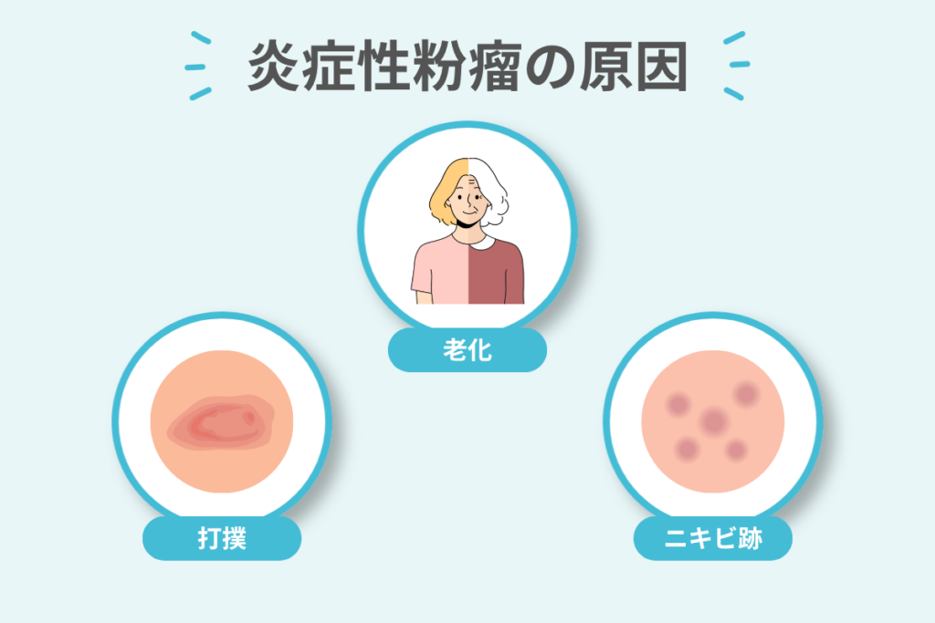 炎症性粉瘤の原因